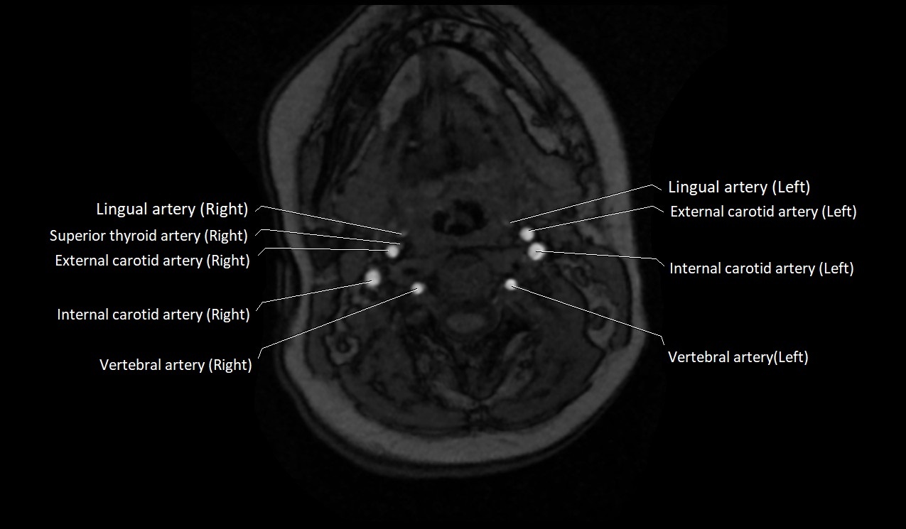 Carotid artery anatomy axial 3T image 24.jpg